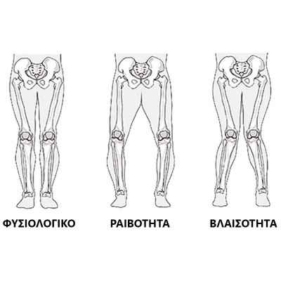 Επιγονατίδες & Νάρθηκες Γόνατου Πλαστικός νάρθηκας οστεοαρθρίτιδας γόνατος OA Vita στη Θεσσαλονικη